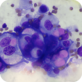 Атипичные клетки